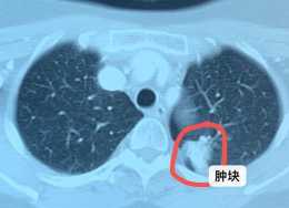 低分化肺癌和高分化肺癌，哪個治療效果好？